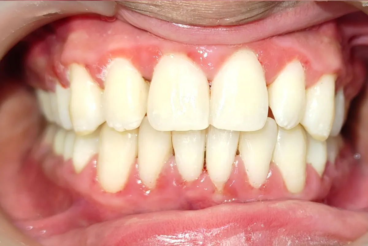 After treatment