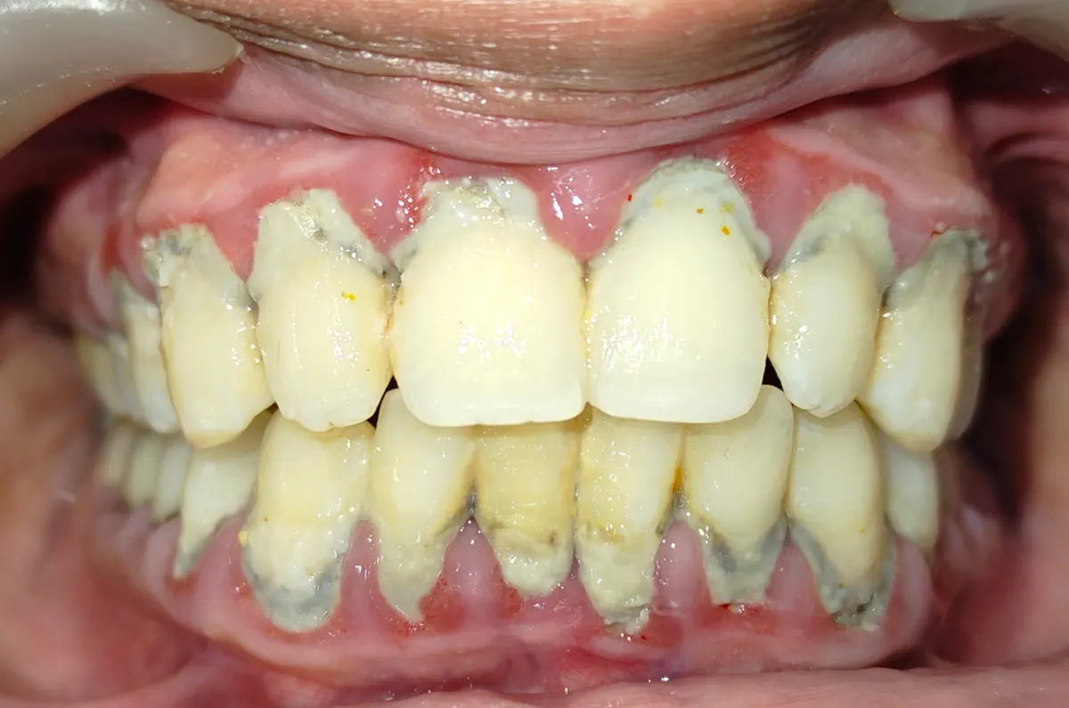 Before treatment