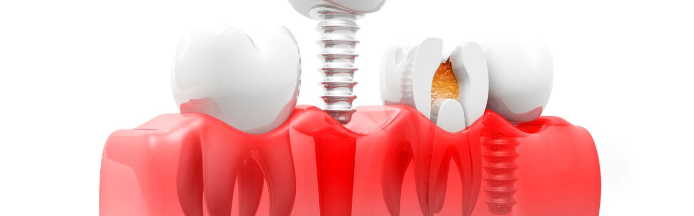 Everything You Need to Know About Dental Implants: Pain, Cost, Insurance & Recovery