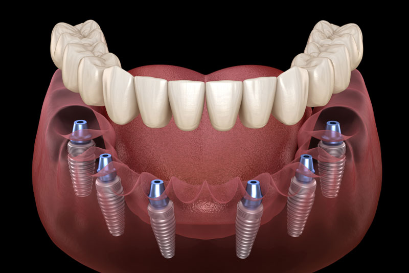 How Dental Implants Can Bring Back Your Confidence and Smile