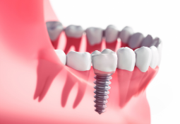 Why You Should Never Ignore a Missing Tooth