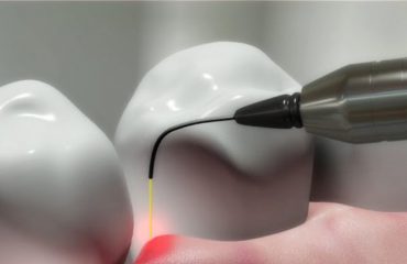 Dental-Lasers